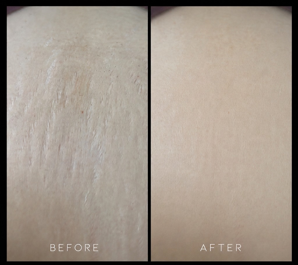 Before and after stretch mark revision